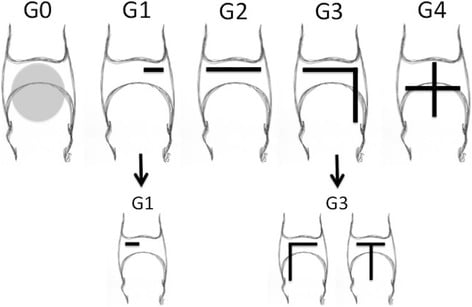 Diagrams of anatomical plantar plate injury grades G0 to G4, with subtypes of G1 and G3 drawn beneath them.