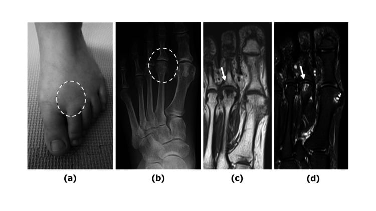 Early second metatarsal head disease: clinical photograph (a) and radiograph (b) with the area circled, and two MRI images (c, d) with arrows at the second metatarsal head.