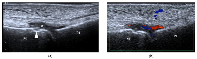 Ultrasound of an inflamed MTP joint between metatarsal (M) and proximal phalanx (P1): B-mode with an asterisk and an arrowhead (a), and Doppler showing flow in the same region (b).