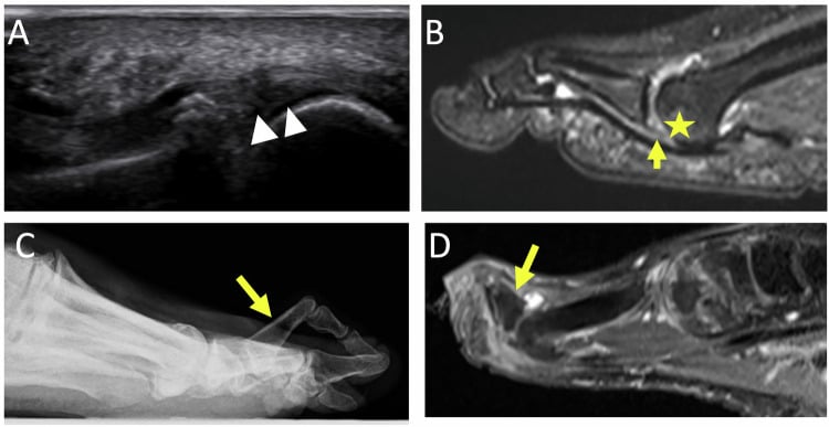 Four panels of second-ray syndrome: ultrasound with arrowheads showing plantar plate irregularity (A), sagittal MRI with a star and an arrow (B), lateral radiograph with an arrow at a toe standing dorsally at the MTP joint (C), and MRI with an arrow (D), showing plantar plate rupture with dorsal subluxation of the proximal phalanx.