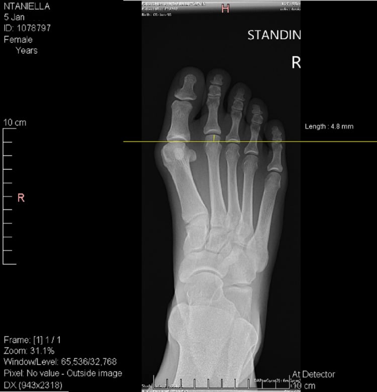 Standing AP radiograph of a right foot with a line drawn at the level of the first metatarsal head and the second metatarsal head projecting a measured 4.8 mm beyond it.