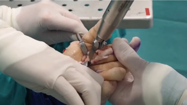 Intraoperative photograph of the first saw cut of a triple Weil osteotomy, made through a dorsal forefoot incision with the wound retracted and the toe held.