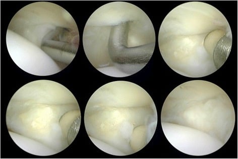Six arthroscopic views of a lesser MTP joint during treatment of a grade I plantar plate tear with a probe and a radiofrequency device.