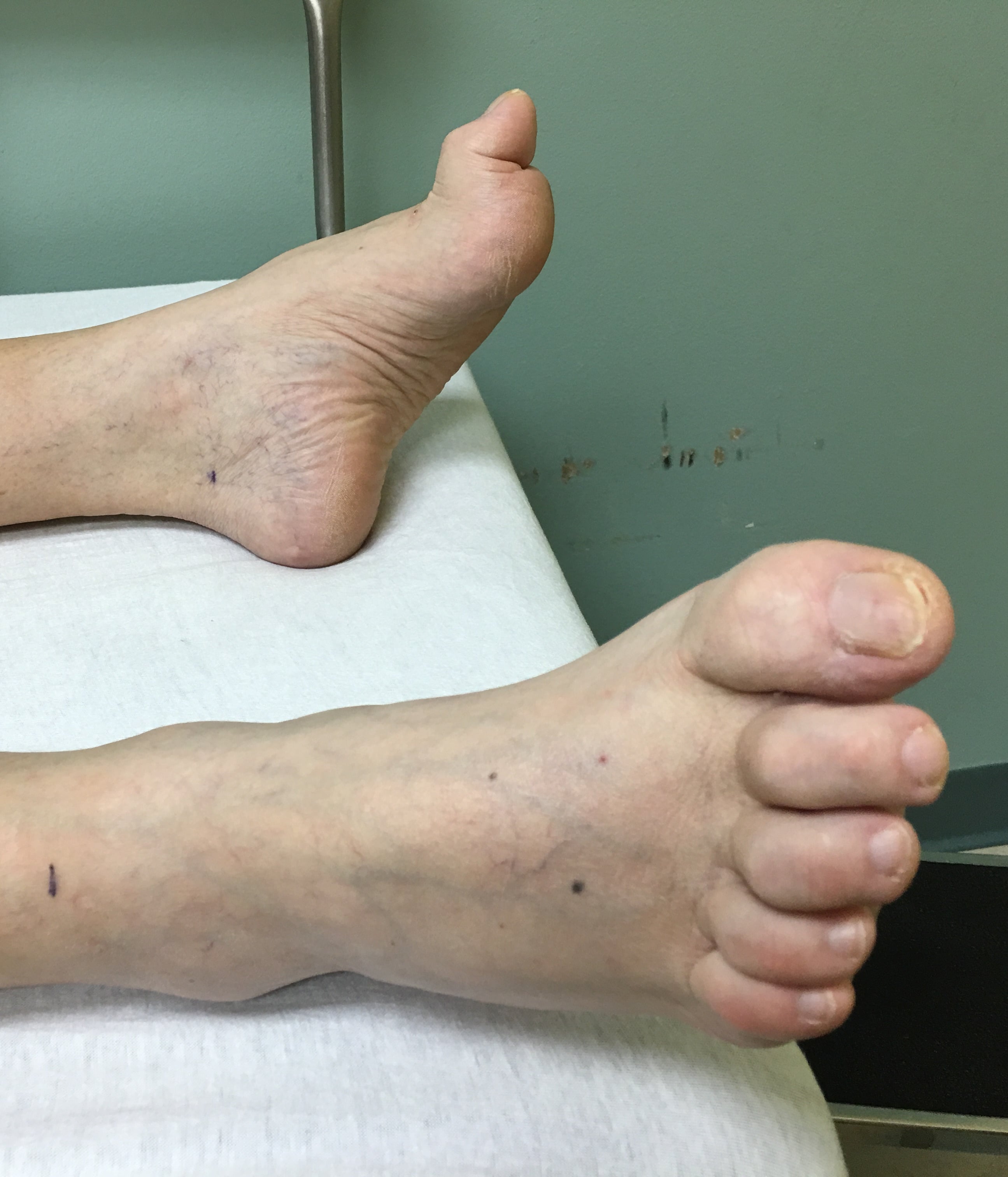 Clinical photograph of both feet showing lesser toe deformities