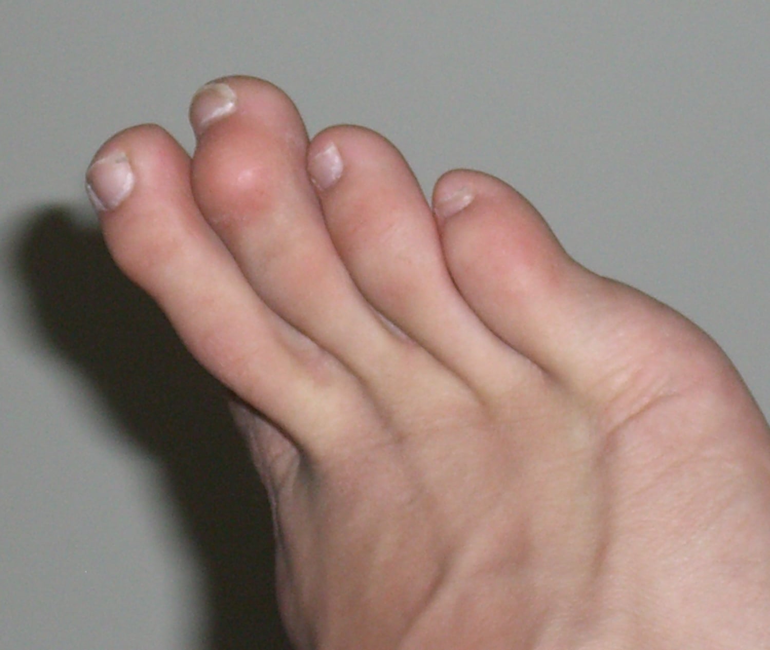 Clinical photograph of the lesser toes with a mallet deformity of the third toe, its tip curled down at the distal joint