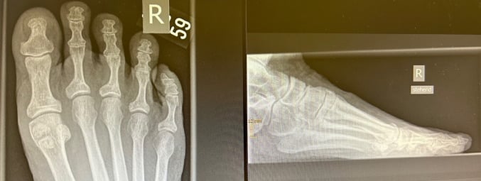 Long-term radiographs after minimally invasive correction of second- and third-toe hammer deformities