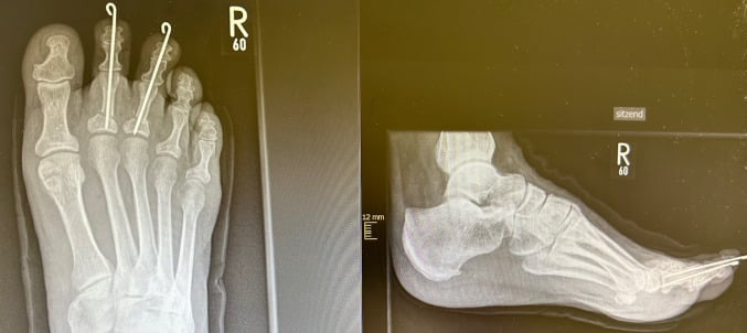 Immediate postoperative anteroposterior and lateral radiographs after minimally invasive correction of second- and third-toe hammer deformities, with an axial K-wire in each toe