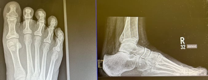 Preoperative weight-bearing radiographs of second- and third-toe hammer deformities