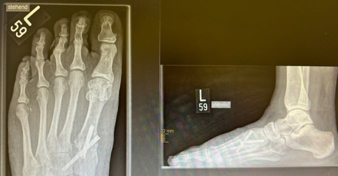 Long-term radiographs after open correction of a second-toe hammer deformity