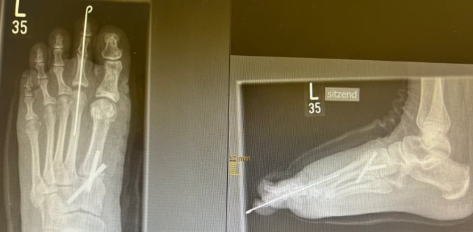 Immediate postoperative anteroposterior and lateral radiographs after open correction of a second-toe hammer deformity, with an axial K-wire in the second ray and a second set of crossing implants more proximally