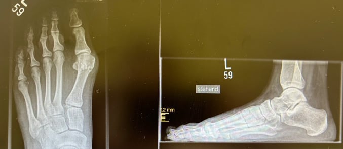 Preoperative weight-bearing radiographs of an isolated second-toe hammer deformity