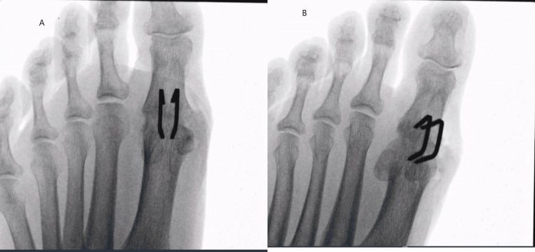 Preoperative AP foot radiograph demonstrating hammer toe deformity of the lesser digits