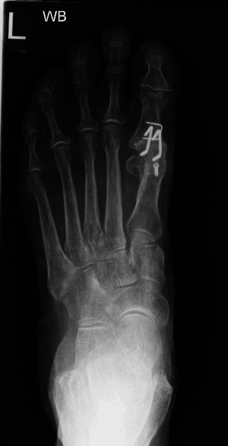 Intraoperative fluoroscopy demonstrating PIP joint resection and intramedullary implant insertion