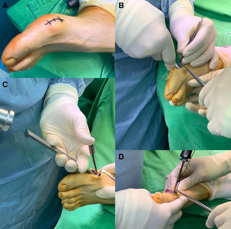 Weightbearing AP and lateral foot radiographs demonstrating Weil metatarsal osteotomy