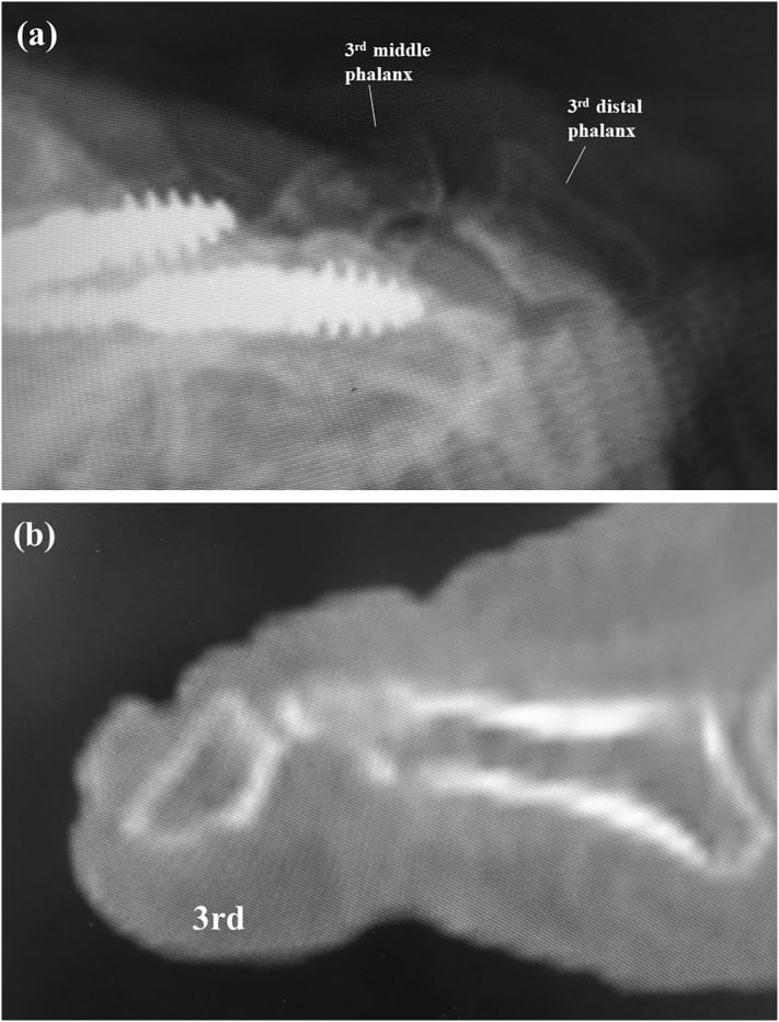 Lateral radiograph with the third middle and distal phalanges labelled, and sagittal CT of the third toe, after implant removal and flexor tenotomy for mallet toe