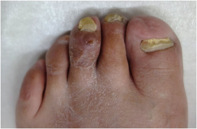 One-year clinical follow-up after flexor tenotomy for mallet toe