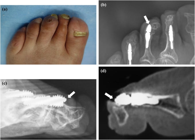 Four panels: clinical photograph, two radiographs and a sagittal CT, with arrows marking an intramedullary implant penetrating the dorsal middle phalanx head during mallet-toe progression
