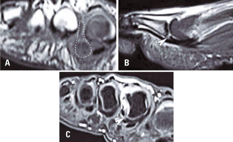 Multiplanar MRI showing a complete second-toe plantar plate tear