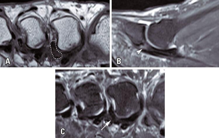 Multiplanar MRI showing degenerative second-toe plantar plate injury