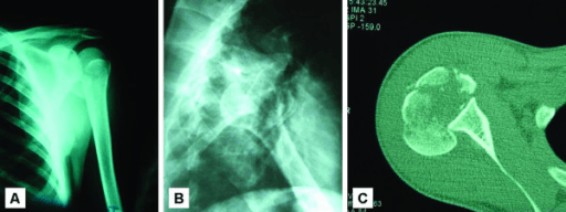 Three-panel posterior shoulder fracture-dislocation: AP, axillary and axial CT