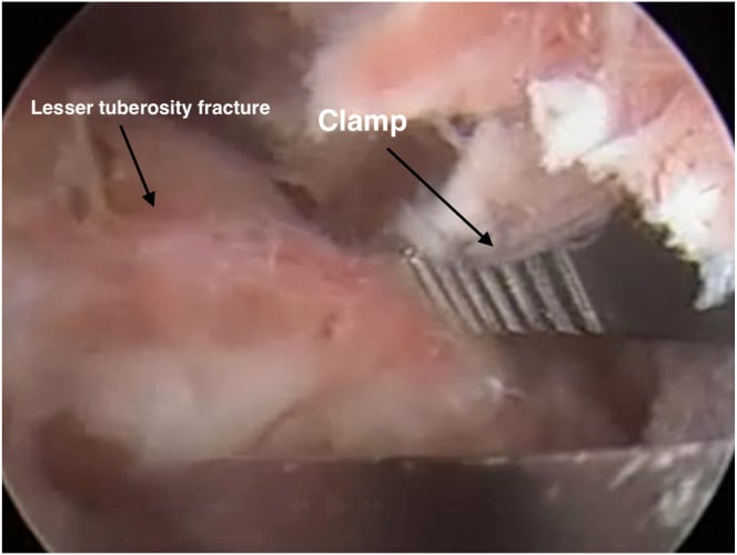 Arthroscopic view of a clamp reducing a lesser tuberosity fracture fragment