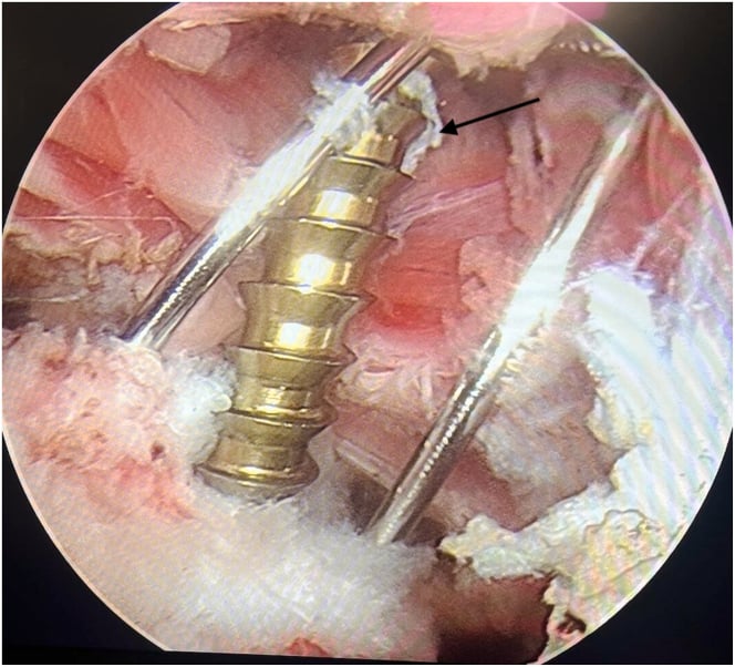 Arthroscopic view of cannulated screw fixation with supporting guidewires in a lesser tuberosity fragment