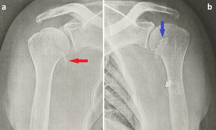 Bilateral AP shoulder radiographs with arrows marking displaced lesser tuberosity avulsion fractures