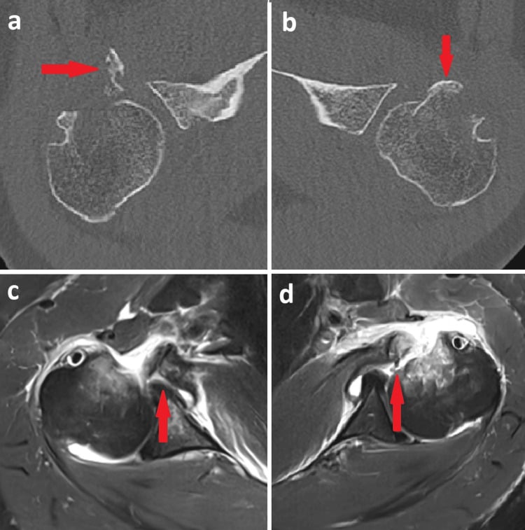 Bilateral axial CT and MRI showing displaced lesser tuberosity fragments with attached subscapularis tendons