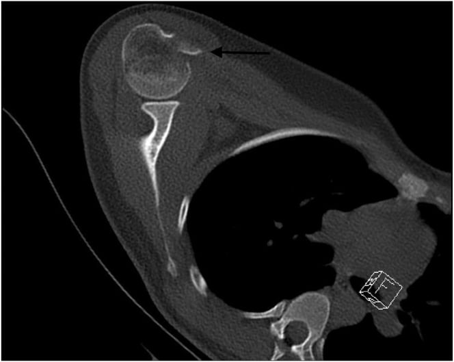 Axial CT showing a displaced lesser tuberosity avulsion fragment anterior to the humeral head