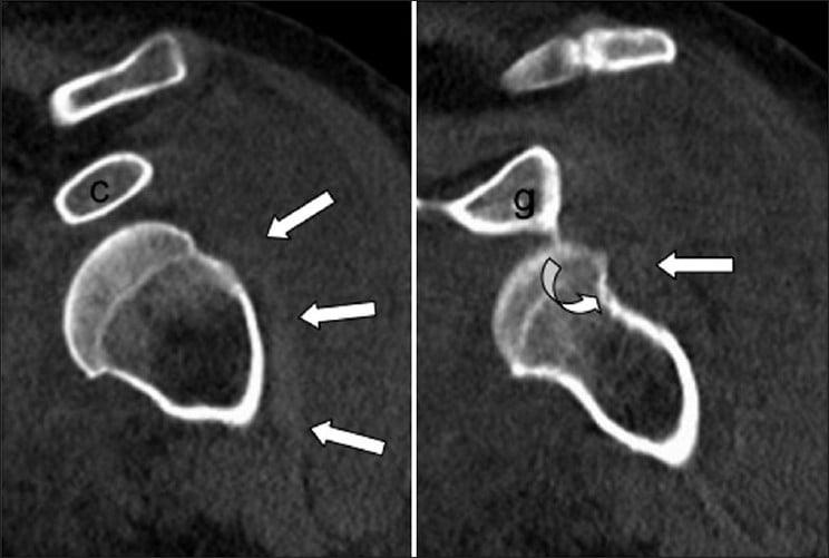 Oblique coronal CT reconstructions showing the long head of biceps displaced lateral and posterior to the humeral neck