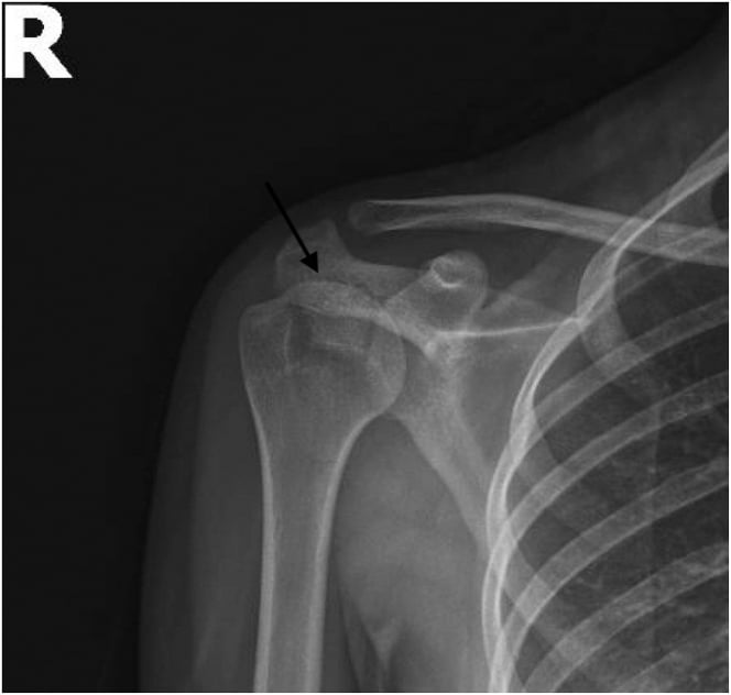 AP radiograph with an arrow marking a lesser tuberosity avulsion fragment superimposed on the proximal humerus