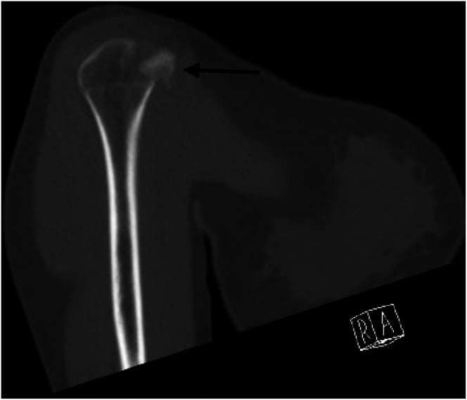 Coronal CT showing a displaced lesser tuberosity fracture fragment