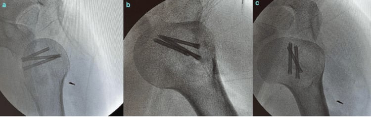 Intraoperative fluoroscopic sequence in internal neutral and external rotation after modified McLaughlin fixation