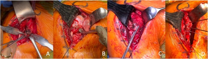 Draped operative sequence in four panels showing exposure and mobilisation of a chronic lesser tuberosity fragment and anchor fixation