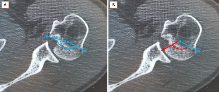 Axial CT with intact and deficient humeral-head articular arcs drawn across a reverse Hill-Sachs lesion
