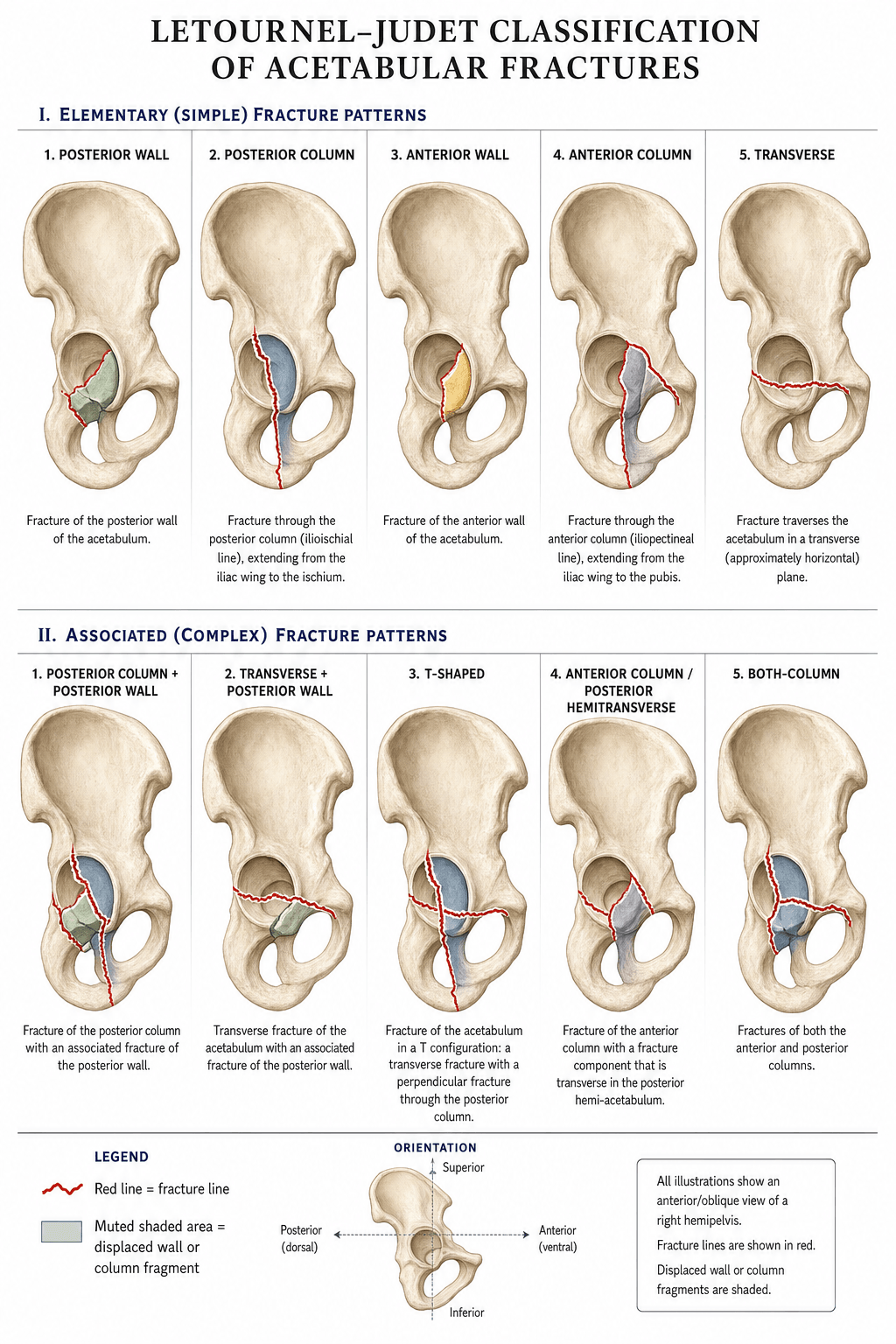 Atlas of the ten Letournel-Judet acetabular fracture patterns (five elementary, five associated) drawn on a right hemipelvis with red fracture lines and shaded displaced fragments.