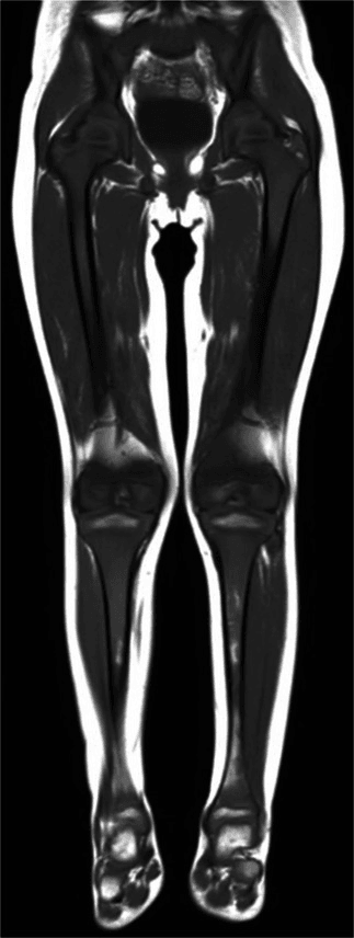 Coronal T1 MRI showing diffuse marrow replacement in childhood ALL