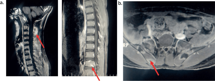 MRI showing multifocal vertebral and pelvic lesions in acute lymphoblastic leukaemia