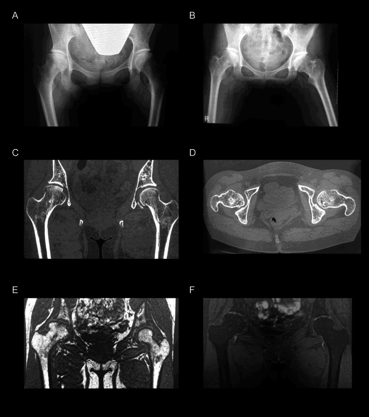 Radiograph CT and MRI of femoral-head osteonecrosis after ALL treatment