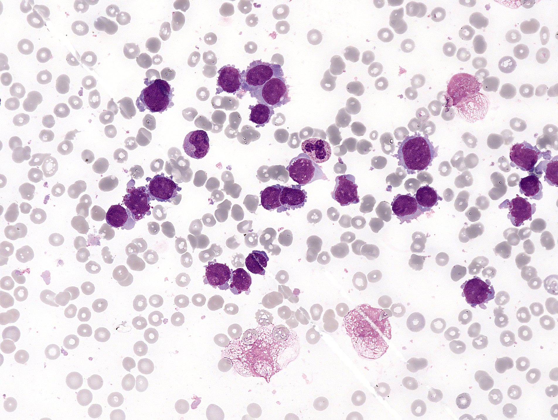 Bone marrow smear showing numerous leukaemic blast cells