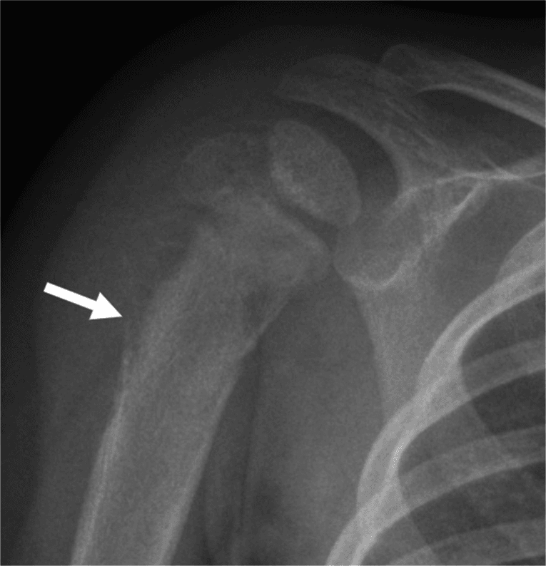Radiograph showing an aggressive humeral metastasis from neuroblastoma