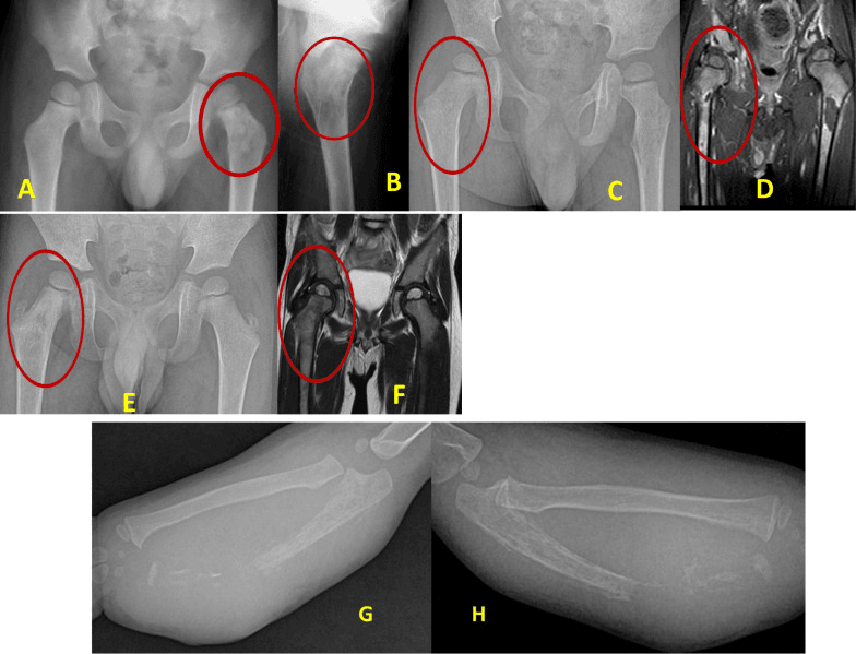 Multifocal osteolytic lesions in children with metastatic neuroblastoma