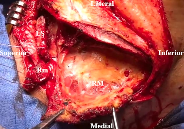 Posterior operative view with levator scapulae and rhomboids mobilised to expose the deep dissection plane.