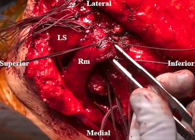 Posterior operative view showing levator scapulae and rhomboid minor fixed along the scapular spine.