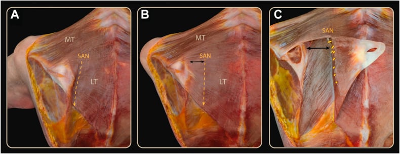 Cadaveric sequence showing how scapular position changes the distance between the spinal accessory nerve and medial scapular border.