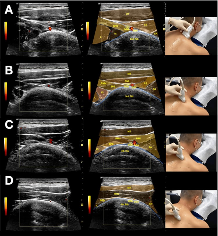 Serial ultrasound images locating the dorsal scapular nerve beside the medial scapular muscles from the second to fifth ribs.