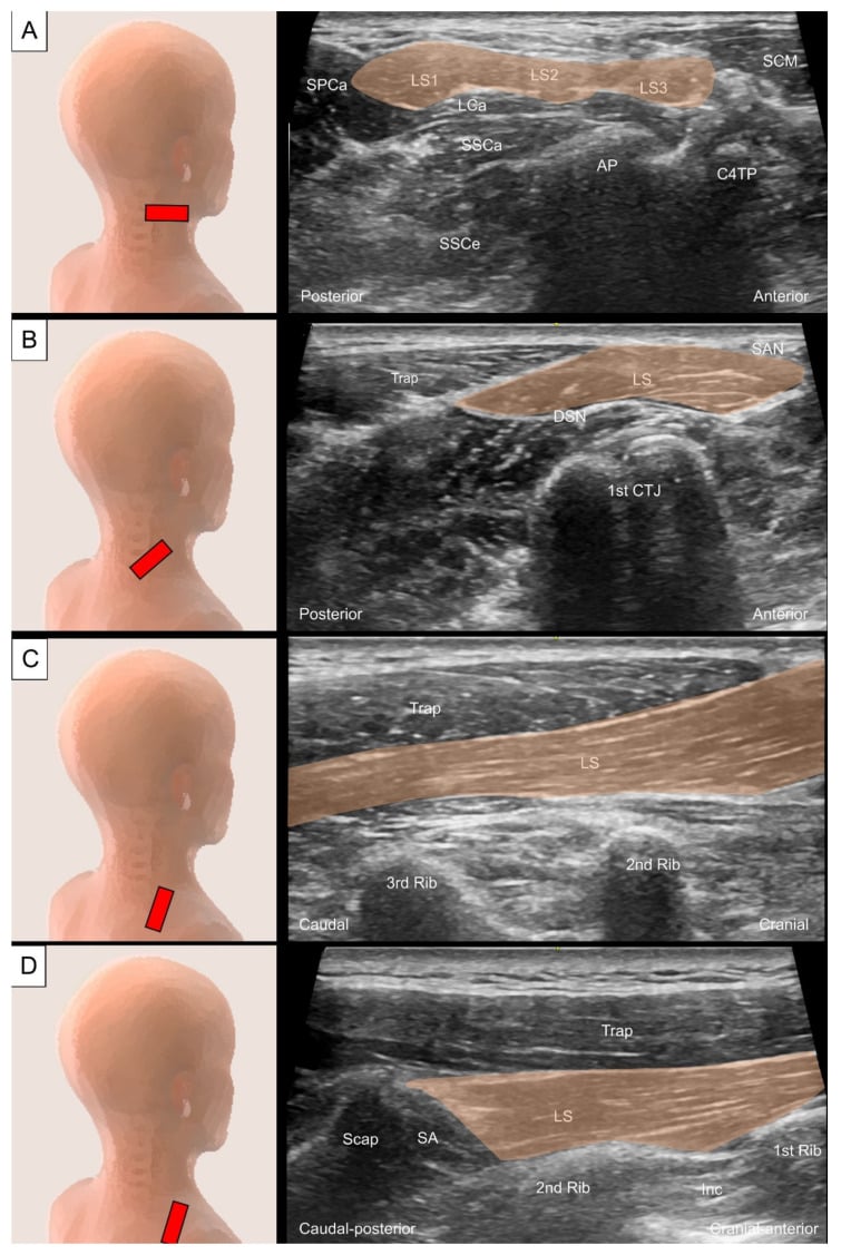 Surface windows and ultrasound views tracing levator scapulae from the upper cervical transverse processes to its scapular insertion.