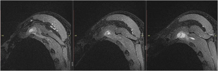 Sequential shoulder MRI slices showing fluid and inflammation in the scapulothoracic bursa.