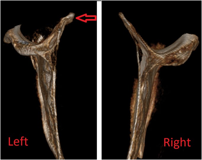 Three-dimensional CT comparison showing a left superomedial scapular deformity against the normal opposite scapula.