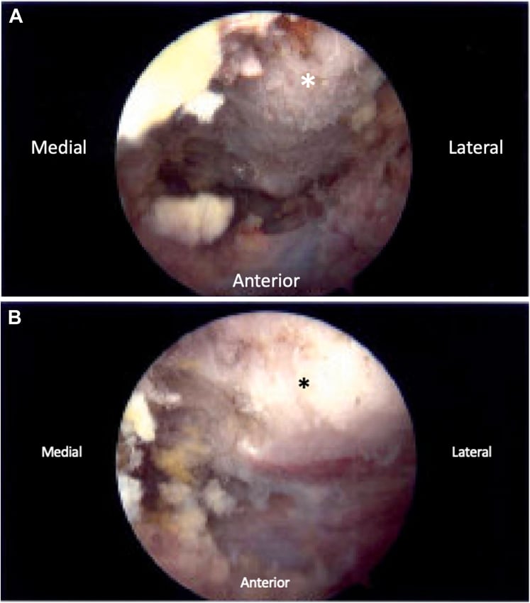 Arthroscopic views of the superomedial scapular angle before and after controlled bony resection.